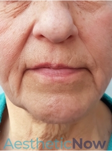 Botox #5-before