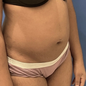 Lipo w Renuvion #10-before