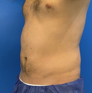 Liposuction #4-after