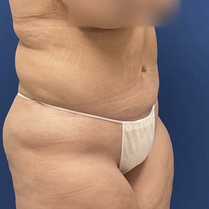 Mommy Makeover #2-after