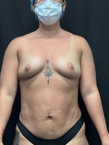 Breast Aug 405cc-after