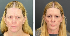 Botox - 20 u forehead, 24 u cf-before