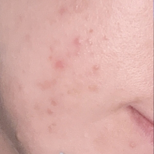 Laser Resurfacing #3-after