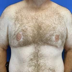 Male Breast Reduction #3 (front)-after