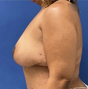 Breast Lift #6-after