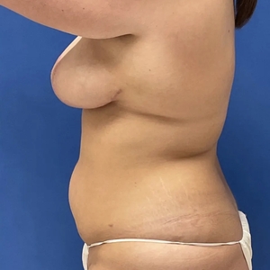 Mommy Makeover #7-after