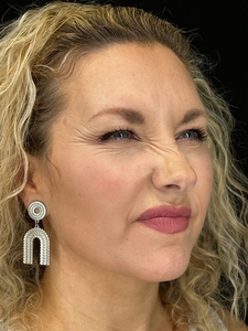 174 Units of Dysport in Crow's Feet and Forehead-before