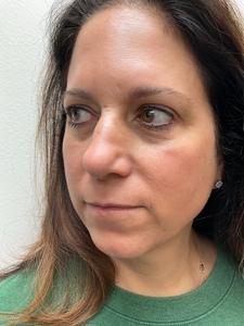 Helix 1 treatment-after