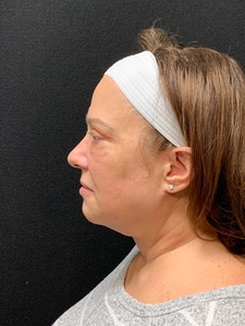 With NanoFat and upper Bleph-after