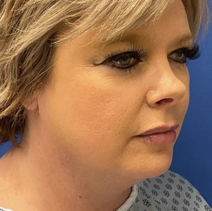 Lipo w Renuvion Face #2 (right oblique)-before