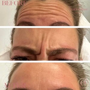 Botox- Neuromodulators-before