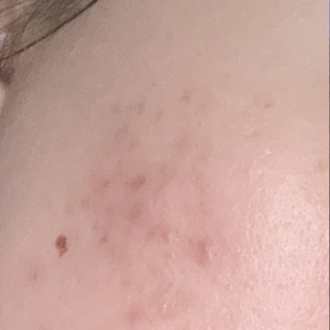 Laser Resurfacing #3-after