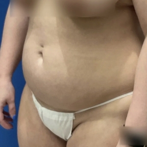 Lipo w Renuvion #2-before