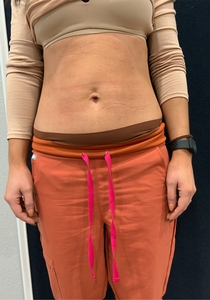 Sylfirm X Stomach - Immediately Following-after