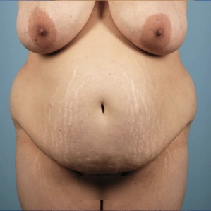 Mommy Makeover #4-before