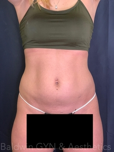 3 weeks after procedure-after