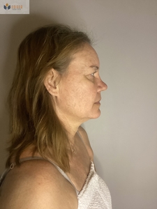 After 1 MN session K. Dorsey-before