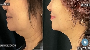 coolsculpting - chin - before and after two treatments-before