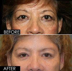Upper & Lower Blepharoplasty plus Fat Graft-before