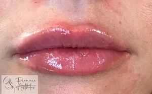 Lips-Restylane Defyne-after