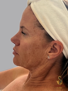 NOUVAglow Mod i week post 1st treatment-before