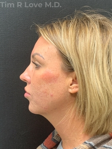 1 week post op chin implant-before