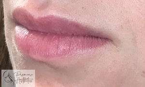 Restylane Kysse Lips-before