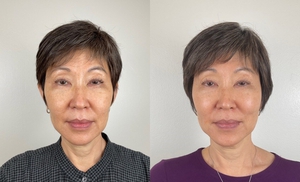 SCULPTRA (2 VIALS)-before