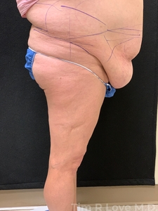 Abdominoplasty - Traditional-before