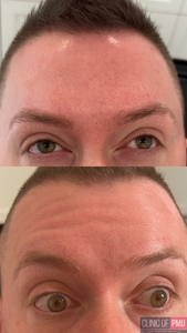 Botox-before