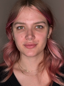 Sydney Burns- Hylenex eyes-before