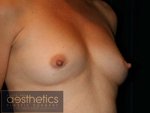 Mentor Smooth Round Saline: R385cc L380cc-before