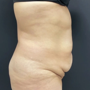 Tummy Tuck #13-before