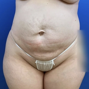 Lipo w Renuvion #8-after