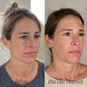 Filler B/A LP-before