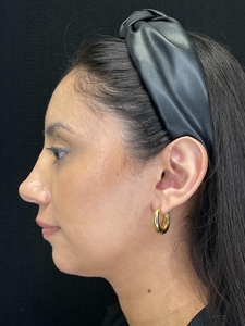 1 syringe Restylane Lyft in chin-before