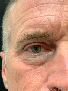 With periorbital Morpheus/Fractora-after