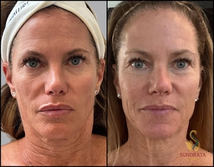 One week post NOUVADerm Mod ablation with spot treatment to pigmentation-before