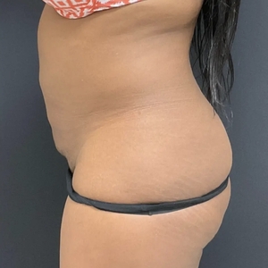Liposuction #5-after
