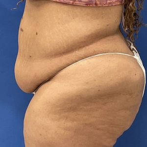 Tummy Tuck #12-before