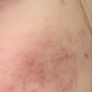 Laser Resurfacing #3-after