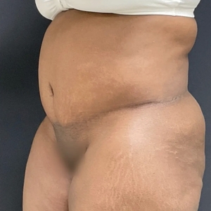 Tummy Tuck #8-after
