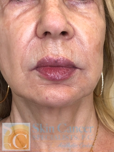 Filler around mouth-after