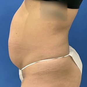 Lipo w Renuvion #5-before