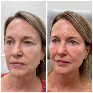Botox-before