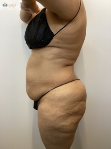 After 1 instasculpt treatment-before