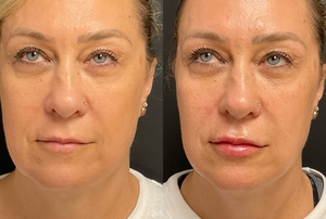 lip filler ultra #barbara-before