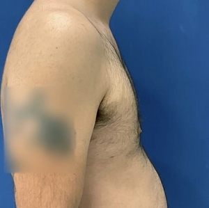 Male Breast Reduction #5-after