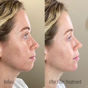 Filler B/A SBA 16-before