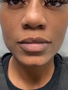 Lip Filler RHA 1cc-before